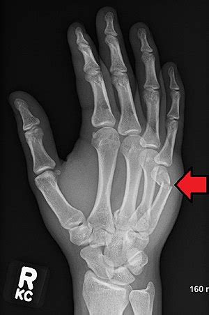 Boxer's fracture - Wikipedia