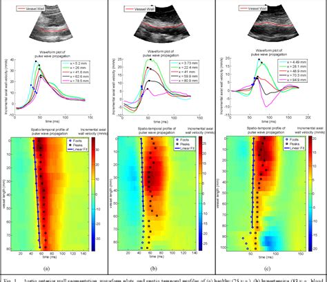 Figure 1 From In Vivo Pulse Wave Imaging For Arterial Stiffness