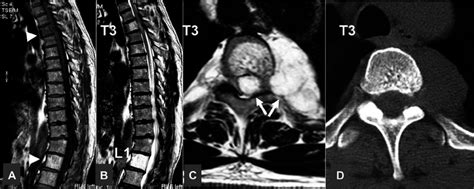 Case 10 A 50 Year Old Woman With Myelopathy And Vertebral Hemangiomas