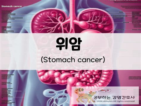 지속적인 속쓰림과 소화불량 “위암”stomach Cancer 원인 및 증상 치료와 예방법