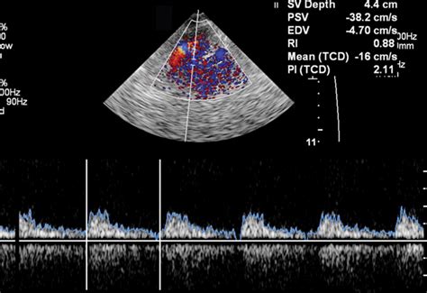 Advances In Transcranial Doppler Us Imaging Ahead Radiographics