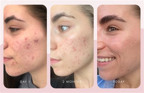 Skin Care Before And After