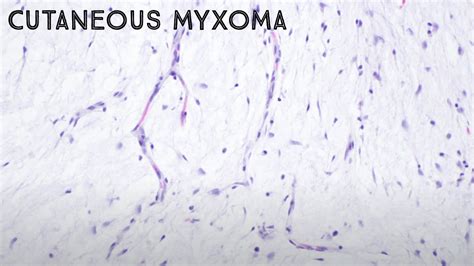 Cutaneous Myxoma Superficial Angiomyxoma Short Video Kiko Xp