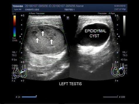 Epididymal Cyst Ultrasound