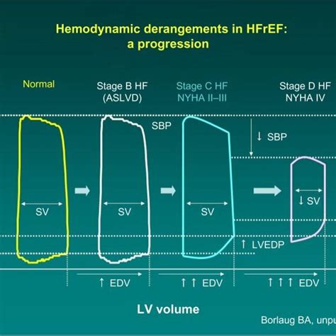 Progression Of Hemodynamic Derangements In Heart Failure Barry