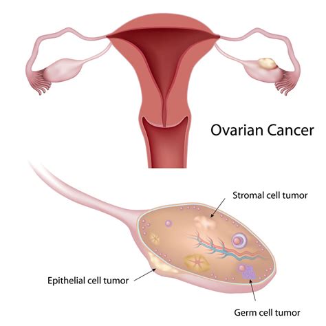 Ovarian Cancer - Net Health Book