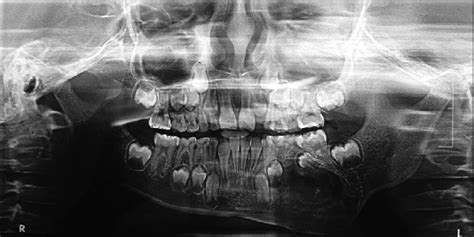 Orthopantomograph Showing Mixed Radiolucentradiopaque Lesion In The