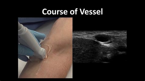 Ultrasound Guided Peripheral Vascular Access BAVLS YouTube