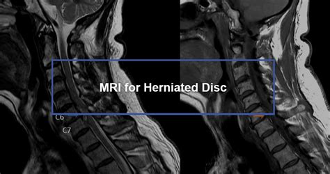 Mri For Herniated Disc Dr Kevin Pauza The Discseel® Procedure Inventor