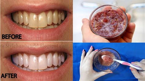 Best Teeth Whitening At Home Remedies । Best Fastest Way To Whiten