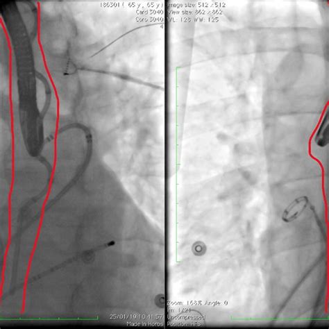 Approaches To The Diagnosis And Management Of Atrial Esophageal Fistula