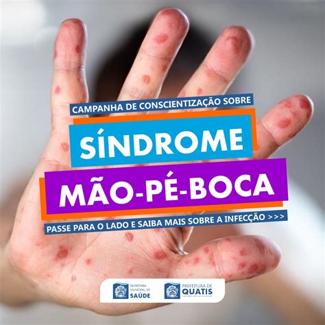 CAMPANHA DE CONSCIENTIZAÇÃO SOBRE A SÍNDROME MÃO PÉ BOCA SMPB