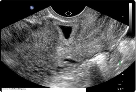 Ectopic Pregnancy In A Cesarean Section Scar Obgyn Key