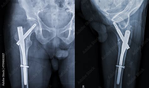 An X Ray Reveals Both Hip Joints With Hemiarthroplasty Showcasing The