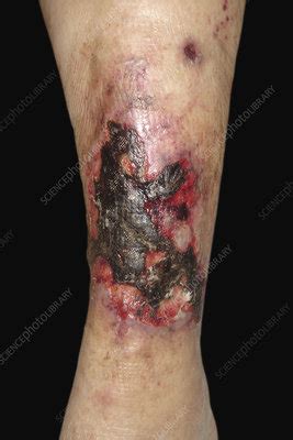 Necrotic Angiodermatitis Stock Image C051 0267 Science Photo Library