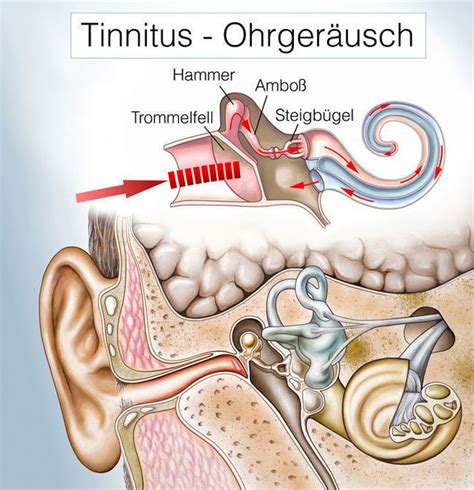 Tinnitus Retraining Therapie TRT Behandlung Und Erfahrungen