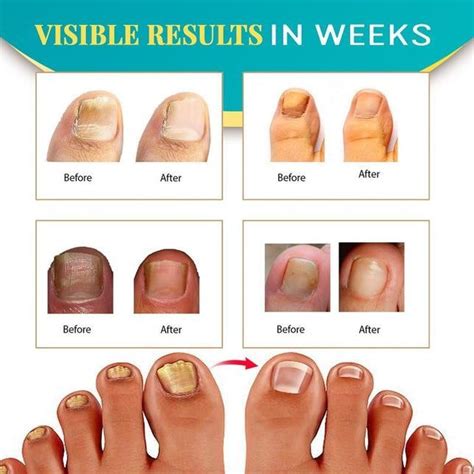 Toenail Fungus Laser Treatment El Paso Tx Artofit