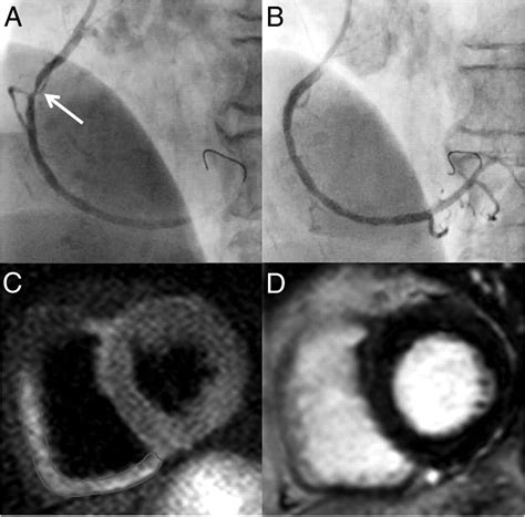 Right Ventricular Injury In St Elevation Myocardial Infarction