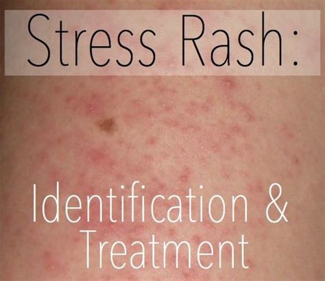 Stress Rash On Neck