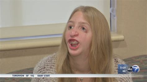 Teen talks about living with Treacher Collins syndrome - ABC7 Chicago