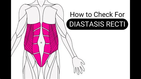 How To Check For Diastasis Recti Youtube