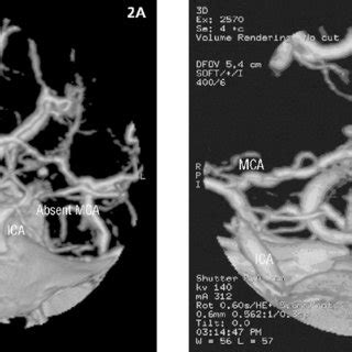 Three Dimensional Reconstruction Of Computed Tomography Ct Angiogram