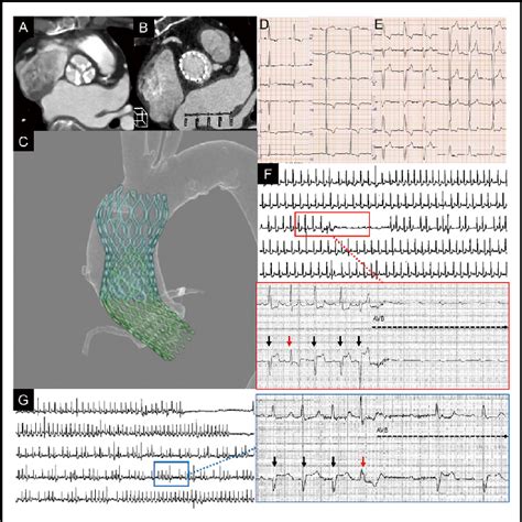 A Pre And B Postoperative Computed Tomography Images Of The Aortic