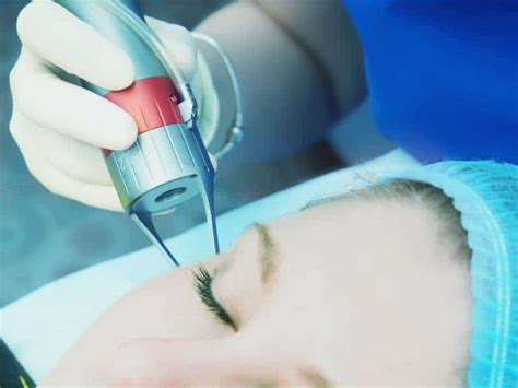 Viva Fractional Skin Resurfacing Indy Laser