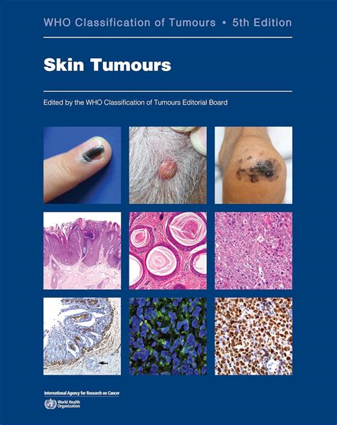 skin tumours  classification  tumours  medicine