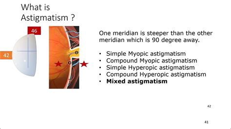 Astigmatism Management With Toric Iols Youtube