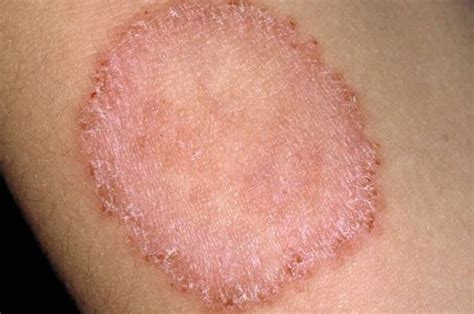 Comprehensive Fungal Infections Treatment In Gurugram Haryana Derma