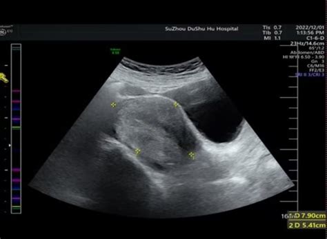 Scivita Medicals 4k Fluorescence Single Port Laparoscopic