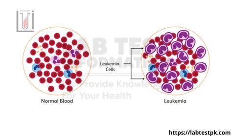 Acute Leukaemia Panel