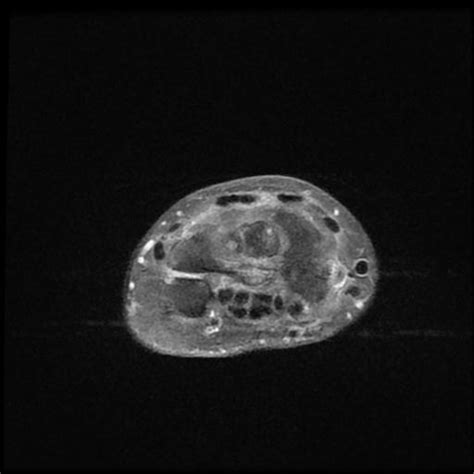 Scaphoid Proximal Pole And Lunate Avascular Necrosis Image