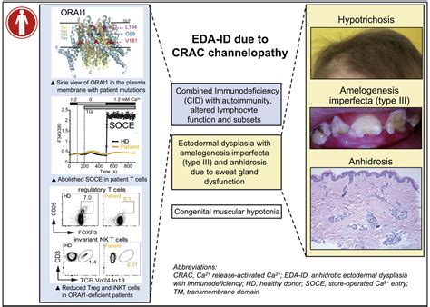 ORAI1 Mutations Abolishing Store Operated Ca2 Entry Cause Anhidrotic