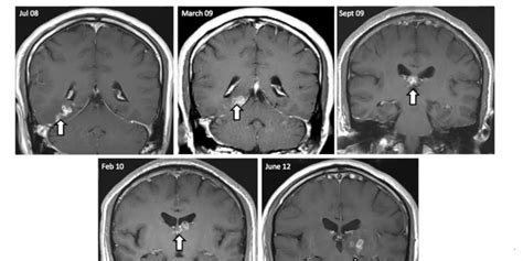 Tapeworm Removed From Mans Brain After 4 Years Video