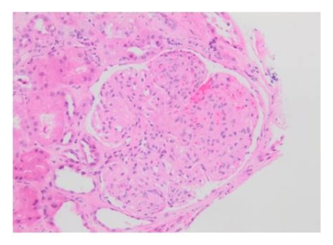 A Glomerulus With Nodularity Mesangial Hypercellularity And