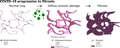 Frontiers Progression To Lung Fibrosis In Severe Covid 19 Patients A