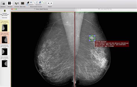 Detecting And Classifying Lesions In Mammograms With Deep Learning