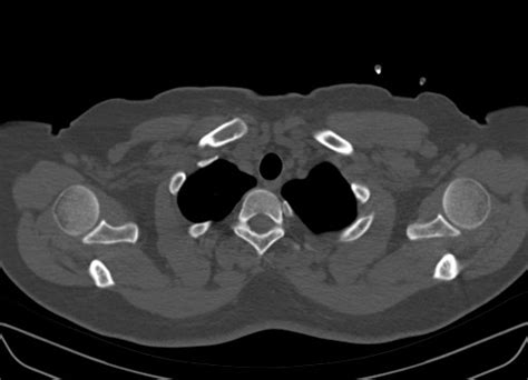 Cervical Ribs Image