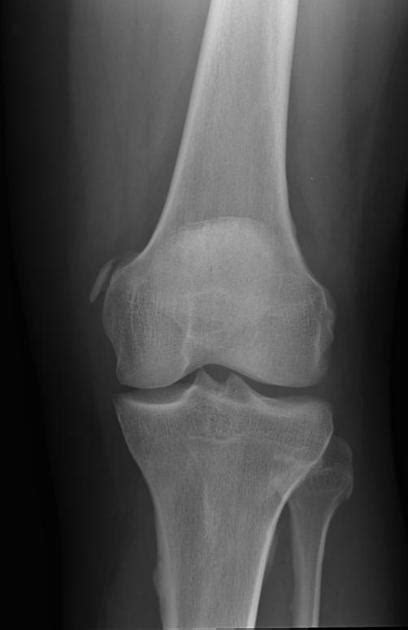 Knee Radiograph An Approach Radiology Reference Article