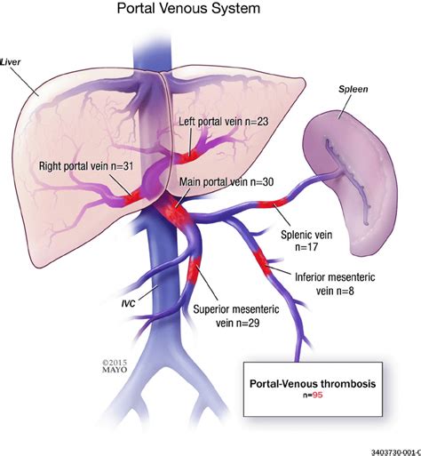 Portal Vein Thrombosis