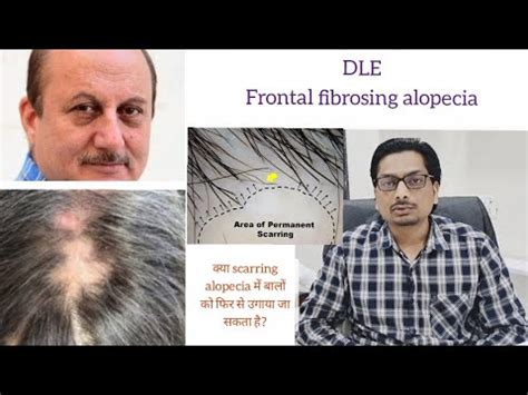 Scarring Alopecia Lichen Planopilaris DLE Frontal Fibrosing