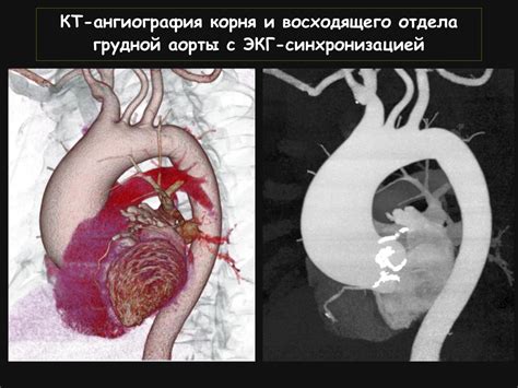 Патология аорты