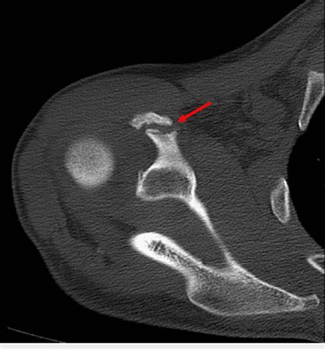 Axial Ct Scan Of The Right Shoulder Showing Coracoid Nonunion In Case 1