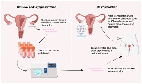 Jcm Free Full Text Ovarian Tissue Cryopreservation For Fertility