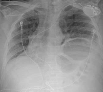 Malpositioned Endocardial Left Ventricular Pacing Lead Extraction With