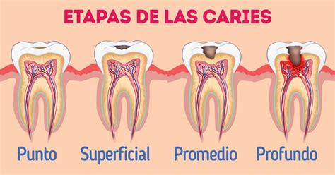 Qué es la caries dental y cómo evitarla Ideas En 5 Minutos