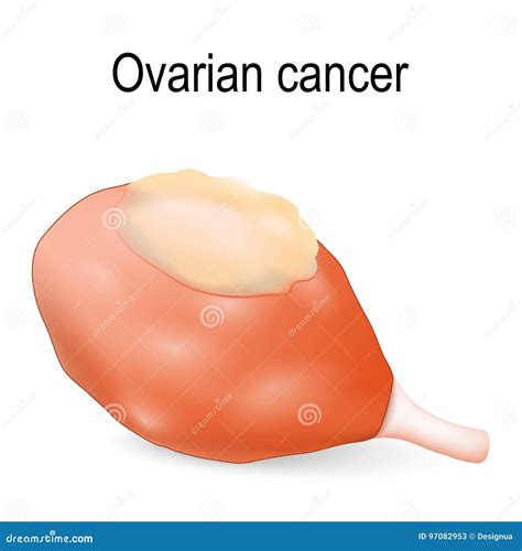 Ovarian Cancer Cartoon Vector 97082953