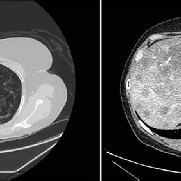 Computerized Tomography Showing Left Lung Spiculated Nodule And